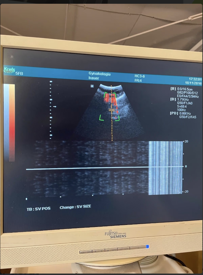 Kretz Sonoace 6000 C mit 4 Sonden Ultraschallgerät